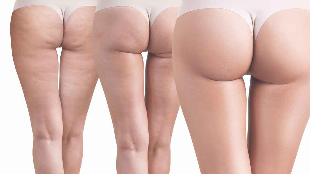 Trois types différents d'implants fessiers : ronds, ovales et en forme de goutte d'eau.