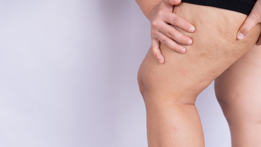 traitement-pour-la-cellulite-solution-efficace