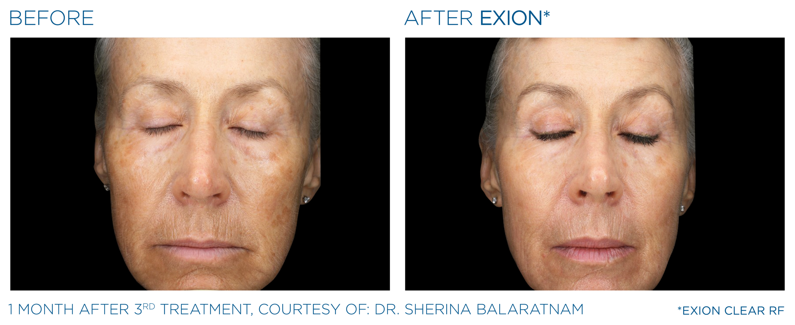 Résultat Exion — Maison DermaSens Blainville