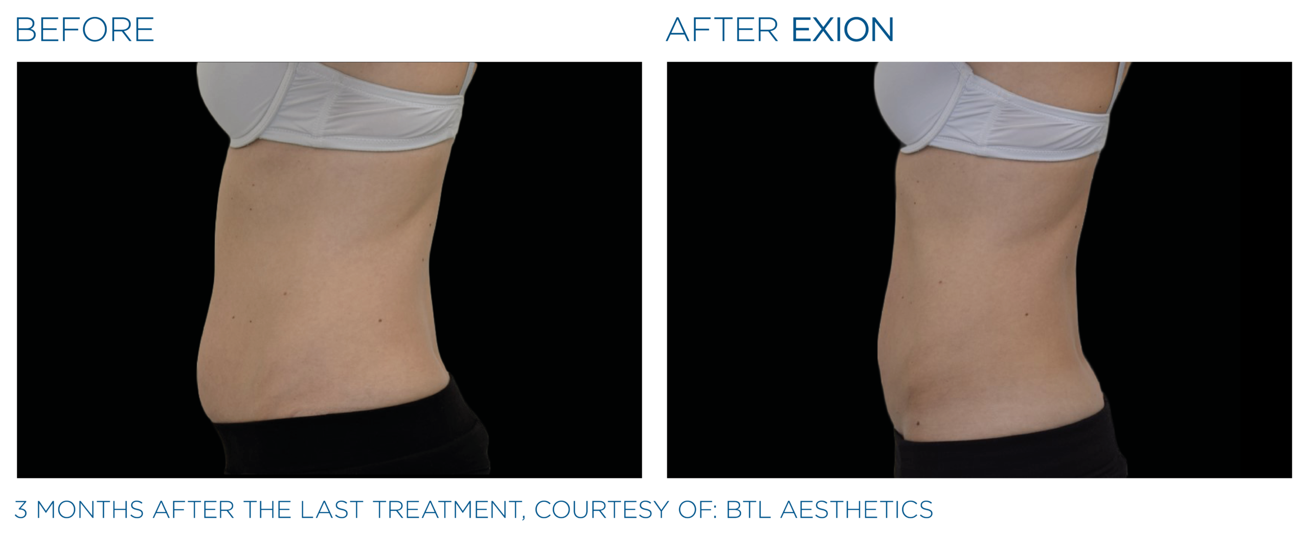 Avant et après Exion — Maison DermaSens Blainville