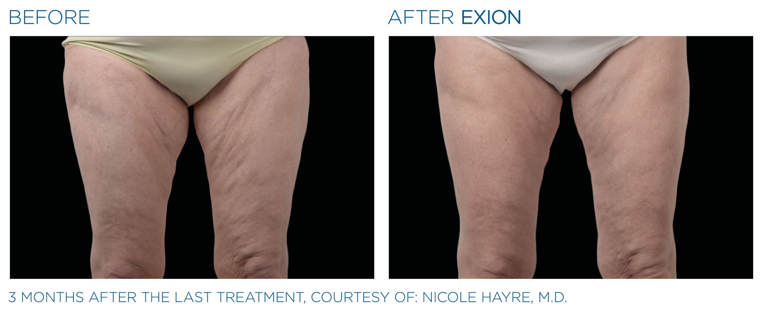 Avant et après Exion — Maison DermaSens Blainville