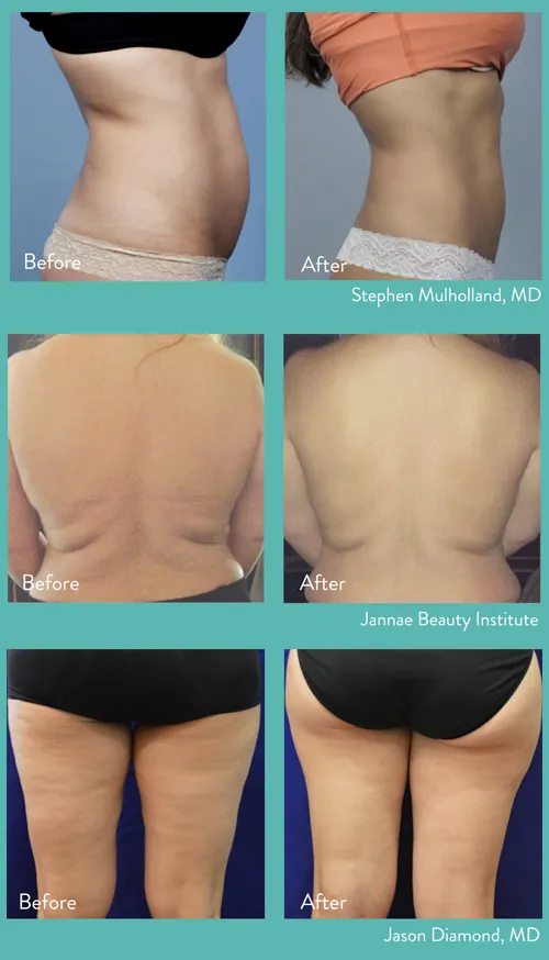 Avant et après un traitement BodyFX sur l'abdomen, le dos et les cuisses